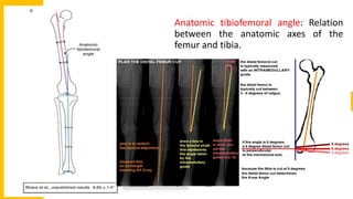 Anatomic tibiofemoral angle: Relation
between the anatomic axes of the
femur and tibia.
 