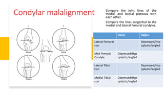 Compare the joint lines of the
medial and lateral plateaus with
each other.
Compare the lines tangential to the
medial and lateral femoral condyles.
Condylar malalignment
Varus Valgus
Lateral Femoral
con
Depressed/Hyp
oplastic/angled
Med Femoral
Condyle
Depressed/Hyp
oplastic/angled
Lateral Tibial
Con
Depressed/Hyp
oplastic/angled
Medial Tibial
con
Depressed/Hyp
oplastic/angled
 