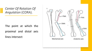 Center Of Rotation Of
Angulation (CORA).
The point at which the
proximal and distal axis
lines intersect
 