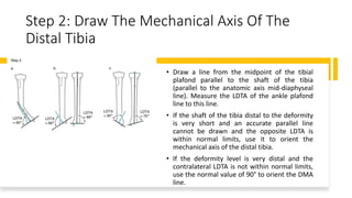 Step 2: Draw The Mechanical Axis Of The
Distal Tibia
• Draw a line from the midpoint of the tibial
plafond parallel to the shaft of the tibia
(parallel to the anatomic axis mid-diaphyseal
line). Measure the LDTA of the ankle plafond
line to this line.
• If the shaft of the tibia distal to the deformity
is very short and an accurate parallel line
cannot be drawn and the opposite LDTA is
within normal limits, use it to orient the
mechanical axis of the distal tibia.
• If the deformity level is very distal and the
contralateral LDTA is not within normal limits,
use the normal value of 90° to orient the DMA
line.
 
