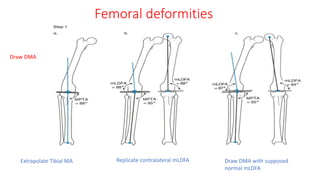 Femoral deformities
Draw DMA
Extrapolate Tibial MA Replicate contralateral mLDFA Draw DMA with supposed
normal mLDFA
 