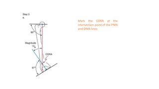 Mark the CORA at the
intersection point of the PMA
and DMA lines
 