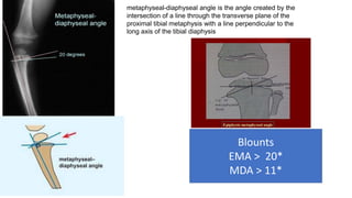 metaphyseal-diaphyseal angle is the angle created by the
intersection of a line through the transverse plane of the
proximal tibial metaphysis with a line perpendicular to the
long axis of the tibial diaphysis
Blounts
EMA > 20*
MDA > 11*
 