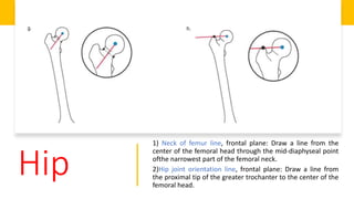 Hip
1) Neck of femur line, frontal plane: Draw a line from the
center of the femoral head through the mid-diaphyseal point
ofthe narrowest part of the femoral neck.
2)Hip joint orientation line, frontal plane: Draw a line from
the proximal tip of the greater trochanter to the center of the
femoral head.
 