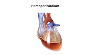 Hemopericardium
 