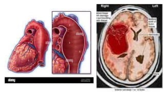 abdominal aortic,
thoracic aortic, and
cerebral.
 