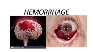 HEMORRHAGE
 