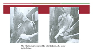 The initial incision which will be extended using the spear 
cut technique 
