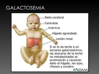 GALACTOSEMIA 