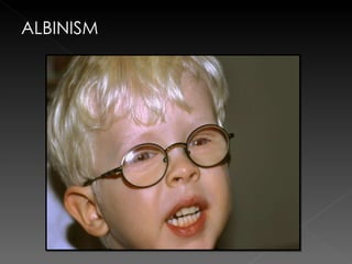 ALBINISM 