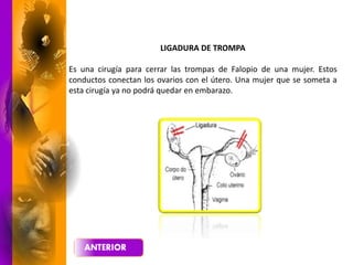 LIGADURA DE TROMPA
Es una cirugía para cerrar las trompas de Falopio de una mujer. Estos
conductos conectan los ovarios con el útero. Una mujer que se someta a
esta cirugía ya no podrá quedar en embarazo.
 