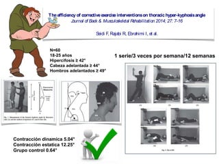 ILIOCOSTAL(1.fibras lumbares, 2.
fibras torácicas, 3. fibras cervicales)
Origen:
1. Cresta iliaca y fascia toracolumbar
2. Costillas 7-12
3. Apófisis transversas cervicales
Inserción:
1. Costillas 6-12
2. Costillas 1-6
3. Apófisis transversas cervicales
Función:
Eje A-P: Inclinación lateral (buena
mecánica, plano predominante)
Eje S-I: Poca rotación
Eje L-M: Extensión (buena mecánica,)
1
2
3
(www.researchreviewservice.com)
The efficiency of correctiveexerciseinterventionson thoracic hyper-kyphosisangle
Journal of Back & Musculoskeletal Rehabilitation 2014; 27: 7-16
Seidi F, Rajabi R, Ebrahimi I, et al.
Reviewed by Dr. CearaHigginsDC (Research Review Service)
ABSTRACT
Background And Objective: Correctiveexerciseinterventionsareoften utilized tomanagesubjectswith
thoracichyper-kyphosis, yet thequalityof evidencethat supportstheir efficiencyislacking. In thisstudy, the
efficacyof local and comprehensivecorrectiveexerciseprograms(LCEPand CCEP) on kyphosisanglewas
evaluated.
Material And Method: A prospective, randomised controlled design wasused in thepresent study. Sixty
patientswith postural hyper-kyphosisdeformity( 42°) entered thestudyfor 12 weeks. Subjectswere⩾
randomlyassigned toaLCEP(n=20), CCEP(n=20), or Control groups(n=20). Pre- and post-participation
levelsof kyphosisangleweremeasured byflexicurveruler.
Results: Both theLCEPand CCEPgroupsdemonstrated statisticallysignificant reductionsin thoracic
kyphosisanglecompared tothecontrol group(p=0.001). Furthermore, based on Cohen'sd-value, the
efficiencyof CCEPwaslarger than LCEP.
Conclusions: Consideringtheextremelylargeeffect sizeof theCCEP, werecommend that thisprogram be
used in thecorrection of postural hyper-kyphosisdeformityin future.
right tragus, acromion processof thescapula, and thespinousprocessof C7 weremarked with
removable, red adhesivedotsand theparticipant wasplaced 9 inchesout from awall which wasset up
with awall mounted grid. A tripod-mounted digital camerawasplaced 104 inchesfrom thewall and
adjusted to placethetripod level with theparticipant’sright shoulder. Theparticipant wasinstructed to
bend forward threetimesand then raisehandsoverhead threetimesbeforeassumingacomfortable,
erect posturewith their weight distributed evenly between their feet and their eyesfixed on theopposite
wall. Threephotoswerethen taken within 5 seconds. AdobeAutoCAD 2010 wasused to measurethe
anglebetween alineconnecting thetragusand C7 and avertical linethrough C7 (forward head angle)
and theanglebetween alineconnectingC7 and theacromion and thesamevertical line(forward
shoulder angle). Theaveragefrom thethreephotoswasrecorded asforward head and forward shoulder
anglesfor each participant.
Exercise Interventions:
Both theLCEPand CCEPgroupsweregiven exercisesto perform threetimesper week for 12 weeks
under thedirect supervision of theexaminers.
Local CorrectiveExerciseProgram(LCEP):
TheLCEPgroup received exercisesbased on Kendall’stheory that had been included repeatedly in
previousstudies. They aimed to stretch thepectoral musclesand strengthen thethoracic extensor
musclesthrough theuseof stretching, self-mobilization, and strengthening, with an emphasison
endurance. In each session theparticipantswarmed up with light aerobic activity for 5 minutes, then
performed two stretching(exercises1 and 2), oneself-mobilization (exercise3), and two strengthening
exercises(exercises4 and 5) sequentially, then cooled down with general stretchingexercisesand slow
walkingfor 5 minutes. Thefoam rollersused in stretching exercise2 weregradually increased in
diameter from 15 cm to 20 cm and then to 25 cm to increasethestretch.
5
oracicKyphosisMeasurement
exicurveruler, 50cm in length and 2cm wide, wasused to measurethoracic kyphosisangle.
movable, red adhesivedotswereused to mark thespinousprocessesof T2 and T12. Participantswere
n asked to stand barefoot on thebaseof aplatform in acomfortable, erect posturewith their body
ght evenly distributed between their feet and their eyesfixed on theoppositewall. Theexaminer
n waited 1-minuteuntil theparticipant returned to their normal posturebeforepositioning two
wels, which werehorizontally mounted on thespinestabilizer instrument (SSI) on an adjustable
nd, to lightly touch thexyphoid processof theparticipant’ssternum and their pubic symphysisin
er to control postural sway. Theexaminer then molded theflexicurveruler to theparticipant’s
racic spineand marked theintersection with thered adhesivedotsat T2 and T12 on theruler with a
ker. Theflexicurveruler wasthen carefully lifted from theparticipant’sspinewithout altering the
figuration of thecurveand placed on apieceof whiteposter board whereit washeld whilean
stant traced theoutlineof thecurveand marked thepointscorresponding toT2 and T12. The
icipant stepped off theplatform for 1-minuteof rest. Theparticipant then stepped back onto the
form into previously traced outlinesof their feet, thespinousprocessesof T2 and T12 wereagain
ked and themeasurement procedurewasrepeated. Thethoracic curvewastraced onto theopposite
eof thewhiteposter board to prevent theinitial contour from influencingtheexaminer. TheT2 and
2 pointson each curvewereconnected usingastraight line(L line) and then thislinewasbisected at
deepest point of thecurve(H line).
esemeasurementswerethen inserted into an equation to calculatethethoracic kyphosisangle. The
rageof thetwo angleswasrecorded asthethoracic kyphosisangleof each participant.
eral photographic techniquewasused to measureforward head and forward shoulder angles. The
4
At theend of week 12 theinitial measurementswererepeated. A repeated measuresANOVA, paire
N=60
18-25 años
Hipercifosis ≥ 42°
Cabeza adelantada ≥ 44°
Hombros adelantados ≥ 49°
Contracción dinamica 5.04°
Contracción estatica 12.25°
Grupo control 0.64°
1 serie/3 veces por semana/12 semanas
 