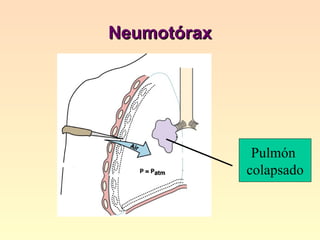 Neumotórax Pulmón  colapsado 