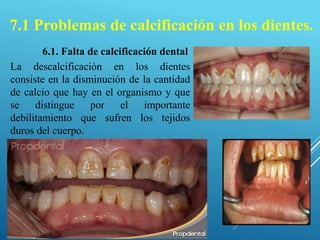 6.1. Falta de calcificación dental
La descalcificación en los dientes
consiste en la disminución de la cantidad
de calcio ...