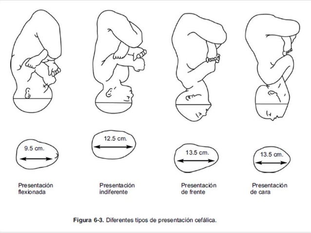 MECANISMO DE PARTO VERTICE OIIA