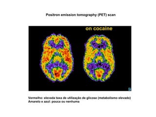 Positron emission tomography (PET) scan Vermelho: elevada taxa de utilização de glicose (metabolismo elevado) Amarelo e azul: pouca ou nenhuma 