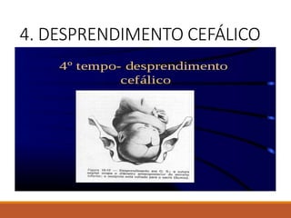 4. DESPRENDIMENTO CEFÁLICO
 