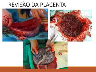 REVISÃO DA PLACENTA
 
