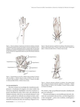 291Rev Bras Reumatol, v. 47, n.4, p. 290-294, jul/ago, 2007
Mecanismo Extensor da Mão: Desvendando a Anatomia e Avaliação por Métodos de Imagem
Figura 1 – Zonas do antebraço. Esquema da vista dorsal do antebraço mostrando
a classificação de Verdan das zonas que dividem os músculos extensores da mão e
antebraço: I. Articulação interfalangiana distal; II. Falange média; III. Articulação
interfalangiana proximal; IV. Falange proximal; V. Articulação metacarpofalangiana;
VI. Dorso da mão; VII. Compartimento extensor do punho; VIII. Músculos extensores
extrínsecos.
Figura 2 – Compartimentos da zona VII: A. Abdutor longo do polegar; B. Extensor
curto do polegar; C. Extensor longo do carpo; D. Extensor curto do carpo;
E. Extensor longo do polegar; F. Extensor do indicador; G. Extensor dos dedos;
H. Extensor do dedo mínimo; I. Extensor ulnar do carpo.
Figura 3 – Músculos extensores superficiais do antebraço. Vista póstero-lateral. 1.
Extensor radial longo do carpo; 2. Extensor radial curto do carpo; 3. Extensor dos
dedos; 4. Extensor do dedo mínimo; 5. Extensor ulnar do carpo.
Figura 4 – Músculos extensores profundos do antebraço. Vista póstero-lateral
após a remoção dos músculos extensores superficiais. 6. Supinador; 7. Abdutor
longo do polegar; 8. Extensor curto do polegar; 9. Extensor longo do polegar;
10. Extensor do indicador.
Ultra-sonografia
	Recentes avanços na tecnologia dos transdutores pro-
piciaram a visualização de imagens com maior nitidez das
estruturas superficiais. Qualidades como boa resolução es-
pacial, velocidade do exame, baixo custo, não-utilização de
radiação ionizante, além de ser um método dinâmico e não
invasivo, podendo ser utilizado em avaliação seriada, confe-
rem especial importância à ultra-sonografia na avaliação dos
músculos extensores da mão e do antebraço (Figuras 5 e 6).
No entanto, exige um profissional treinado e familiarizado
para sua realização(6)
.
Processos patológicos como proliferação sinovial e der-
rame são características das sinovites, com fácil diagnóstico
à ultra-sonografia(7)
, assim como tendinite, tendinopatia e
rupturas completas(8)
.
Compartimento 5 { H
Compartimento 6 { I
Compartimento 4
G
F
}
Compartimento 2
D
C
}
Compartimento 1
B
A }
E } Compartimento 3
3 4
2
1
5
6
9
7
8
10
V
 
