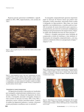 292 Rev Bras Reumatol, v. 47, n.4, p. 290-294, jul/ago, 2007
Francisco e cols.
Tomografia computadorizada
	Os ligamentos do punho e mão podem ser visualizados
por tomografia computadorizada multidetectores e resso-
nância magnética. Na avaliação dos ligamentos do dorso
da mão, a tomografia, associada à artrografia, mostrou-se
mais acurada na detecção de lesões (83% versus 78%) e
apresentou menor variação interobservadores. Todavia,
na análise dos ligamentos palmares e centrais, a literatura
mostra performance semelhante entre os métodos(9)
.
Figura 6 – Ultra-sonografia do punho. Vista axial. Compartimentos do punho.
1. Compartimento 1 do punho (abdutor longo do polegar e extensor curto do
polegar); 2. Compartimento 2 do punho (extensor longo do carpo e extensor
curto do carpo); 3. Compartimento 3 do punho (extensor longo do polegar);
4. Compartimento 4 do punho (extensor do indicador e extensor dos dedos);
5. Compartimento 5 do punho (extensor do dedo mínimo); 6. Compartimento 6
do punho (extensor ulnar do carpo).
Figura 7 – Reformatação 3D de tomografia computadorizada. Vista dorsal do punho.
1. Extensor longo do polegar; 2. Extensor curto do polegar; 3. Abdutor longo do
polegar; 4. Extensor radial longo do carpo; 5. Extensor radial curto do carpo;
6. Extensor do indicador; 7. Extensor dos dedos; 8. Extensor do dedo mínimo;
9. Extensor ulnar do carpo.
Figura 8 – Reformatação 3D de tomografia computadorizada. Vista da região
medial do punho. 1. Abdutor longo do polegar; 2. Extensor curto do polegar;
3. Extensor longo do polegar; 4. Extensor radial longo do carpo; 5. Extensor radial
curto do carpo.
Figura 5 – Ultra-sonografia do punho. Vista axial. Nervo mediano (setas) e canal
de Guyon (setas).
A tomografia computadorizada apresenta importante
papel na detecção de fraturas ósseas que podem estar
associadas a lesões musculares, detectando lesões ocultas
à radiografia ou falsos-positivos. Além disso, nos atuais
aparelhos com multidetectores, o membro pode ser man-
tido em posição de menor desconforto para o paciente e,
posteriormente, por meio de reconstruções multiplanares,
obtidas por pós-processamento das imagens fontes, obtém-
se análise mais detalhada das áreas de maior interesse(10)
.
Clínicos e cirurgiões apresentam maior facilidade de
compreender as lesões do antebraço e mão mediante re-
formatações de tomografia computadorizada e, com isso,
realizam o tratamento clínico ou a programação cirúrgica(11)
(Figuras 7 a 9).
5
6
4
3
7
8
9
2
1
3
4
2
1
5
Rupturas parciais apresentam sensibilidade e especifi-
cidade de 33% e 89%, respectivamente, com acurácia de
75%(2)
.
 