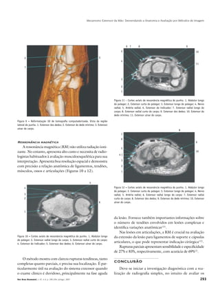 293Rev Bras Reumatol, v. 47, n.4, p. 290-294, jul/ago, 2007
Mecanismo Extensor da Mão: Desvendando a Anatomia e Avaliação por Métodos de Imagem
Ressonância magnética
A ressonância magnética (RM) não utiliza radiação ioni-
zante. No entanto, apresenta alto custo e necessita de radio-
logistas habituados à avaliação musculoesquelética para sua
interpretação. Apresenta boa resolução espacial e demonstra
com precisão a relação anatômica de ligamentos, tendões,
músculos, ossos e articulações (Figuras 10 a 12).
da lesão. Fornece também importantes informações sobre
o número de tendões envolvidos em lesões complexas e
identifica variações anatômicas(12)
.
Nas lesões em articulações, a RM é crucial na avaliação
da extensão da lesão para ligamentos de suporte e cápsulas
articulares, o que pode representar indicação cirúrgica(12)
.
Rupturas parciais apresentam sensibilidade e especificidade
de 27% e 83%, respectivamente, com acurácia de 69%(2)
.
CONCLUSÃO
Deve-se iniciar a investigação diagnóstica com a rea­
lização de radiografia simples, no intuito de avaliar os
Figura 9 – Reformatação 3D de tomografia computadorizada. Vista da região
lateral do punho. 1. Extensor dos dedos; 2. Extensor do dedo mínimo; 3. Extensor
ulnar do carpo.
Figura 10 – Cortes axiais de ressonância magnética do punho. 1. Abdutor longo
do polegar; 2. Extensor radial longo do carpo; 3. Extensor radial curto do carpo;
4. Extensor do indicador; 5. Extensor dos dedos; 6. Extensor ulnar do carpo.
Figura 11 – Cortes axiais de ressonância magnética do punho. 1. Abdutor longo
do polegar; 2. Extensor curto do polegar; 3. Extensor longo do polegar; 4. Nervo
radial; 5. Artéria radial; 6. Extensor do indicador; 7. Extensor radial longo do
carpo; 8. Extensor radial curto do carpo; 9. Extensor dos dedos; 10. Extensor do
dedo mínimo; 11. Extensor ulnar do carpo.
Figura 12 – Cortes axiais de ressonância magnética do punho. 1. Abdutor longo
do polegar; 2. Extensor curto do polegar; 3. Extensor longo do polegar; 4. Nervo
radial; 5. Artéria radial; 6. Extensor radial longo do carpo; 7. Extensor radial
curto do carpo; 8. Extensor dos dedos; 9. Extensor do dedo mínimo; 10. Extensor
ulnar do carpo.
O método mostra com clareza rupturas tendíneas, tanto
completas quanto parciais, e precisa sua localização. É par-
ticularmente útil na avaliação do sistema extensor quando
o exame clínico é duvidoso, principalmente na fase aguda
32
1
6
4
3
5
2
1
5
6
4
3
7 8 9
2
1
10
11
5
6
4 {
3
7
8
9
2
1
10
 