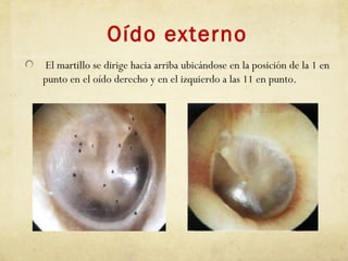 Oído externo
El martillo se dirige hacia arriba ubicándose en la posición de la 1 en
punto en el oído derecho y en el izquierdo a las 11 en punto.
 