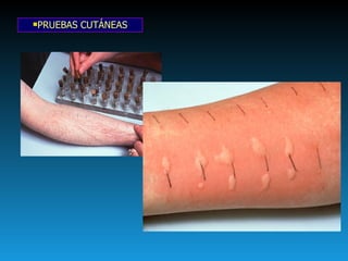 PRUEBAS CUTÁNEAS 