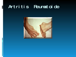 Artritis  Reumatoide 