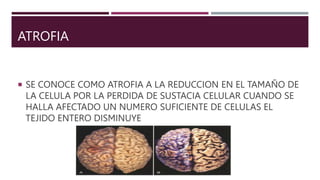 ATROFIA
 SE CONOCE COMO ATROFIA A LA REDUCCION EN EL TAMAÑO DE
LA CELULA POR LA PERDIDA DE SUSTACIA CELULAR CUANDO SE
HALLA AFECTADO UN NUMERO SUFICIENTE DE CELULAS EL
TEJIDO ENTERO DISMINUYE
 