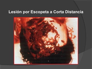 Lesión por Escopeta a Corta Distancia
 