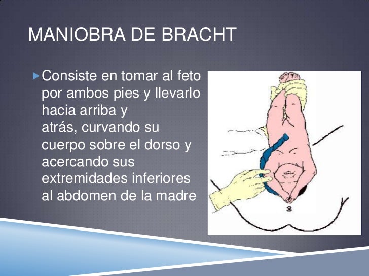 Mecanismos de parto en pelvica