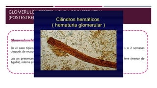 GLOMERULONEFRITIS AGUDA PROLIFERATIVA
(POSTESTREPTOCÓCICA O POSTINFECCIOSA):
Este grupo de enfermedades se caracteriza histológicamente por la proliferación difusa
de las células del glomérulo, asociada a la entrada (exudado) de leucocitos. Esas lesiones
se deben típicamente a inmunocomplejos.
Glomerulonefritis Postestreptocócica:
Esta es una prototípica glomerulopatía causada por inmunocomplejos.
Se presenta entre 1-4 semanas después de la una infección estreptocócica de la faringe o de la piel.
Es más frecuente en niños de 6-10 años.
Es causada por inmunocomplejos que contienen antígenos estreptocócicos y anticuerpos específicos,
formados in situ.
Glomerulonefritis Postestreptocócica:
En el caso típico, un niño presenta malestar, fiebre, nauseas, oliguria y hematuria, 1 o 2 semanas
después de recuperarse de un catarro.
Los px presentan eritrocitos dismorficos o cilindros hemáticos en orina, proteinuria leve (menor de
1g/día), edema preorbitario e hipertensión leve y moderada.
 