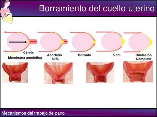 borramiento del cervix