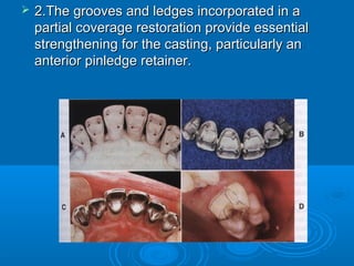Pin Ledge Mech. & esth. principles of preparation ( crown ) | PPT