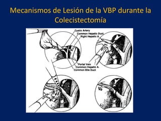 Mecanismos de Lesión de la VBP durante la
Colecistectomía

 