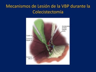 Mecanismos de Lesión de la VBP durante la
Colecistectomía

 