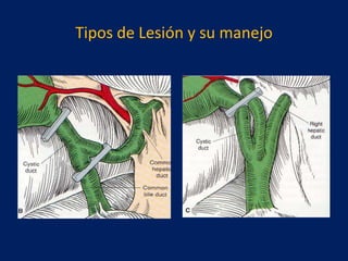 Tipos de Lesión y su manejo

 