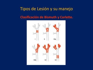 Tipos de Lesión y su manejo
Clasificación de Bismuth y Corlette.

 