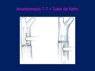 Anastomosis T-T + Tubo de Kehr.

 