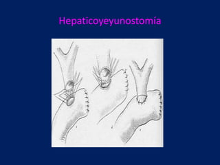 Hepaticoyeyunostomía

 