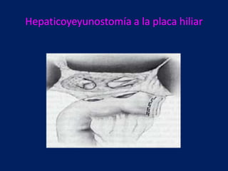 Hepaticoyeyunostomía a la placa hiliar

 