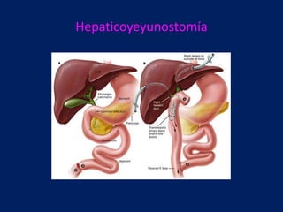 Hepaticoyeyunostomía

 