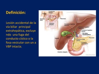 Definición:
Lesión accidental de la
vía biliar principal
extrahepática, excluye
ndo una fuga del
conducto cístico o la
fosa vesicular con un a
VBP intacta.

 