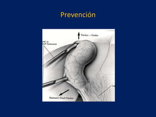 Prevención

 
