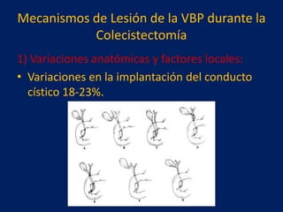 Mecanismos de Lesión de la VBP durante la
Colecistectomía
1) Variaciones anatómicas y factores locales:
• Variaciones en la implantación del conducto
cístico 18-23%.

 