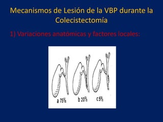 Mecanismos de Lesión de la VBP durante la
Colecistectomía
1) Variaciones anatómicas y factores locales:

 
