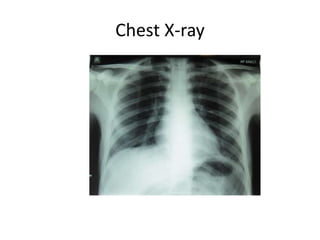 Chest X-ray
 