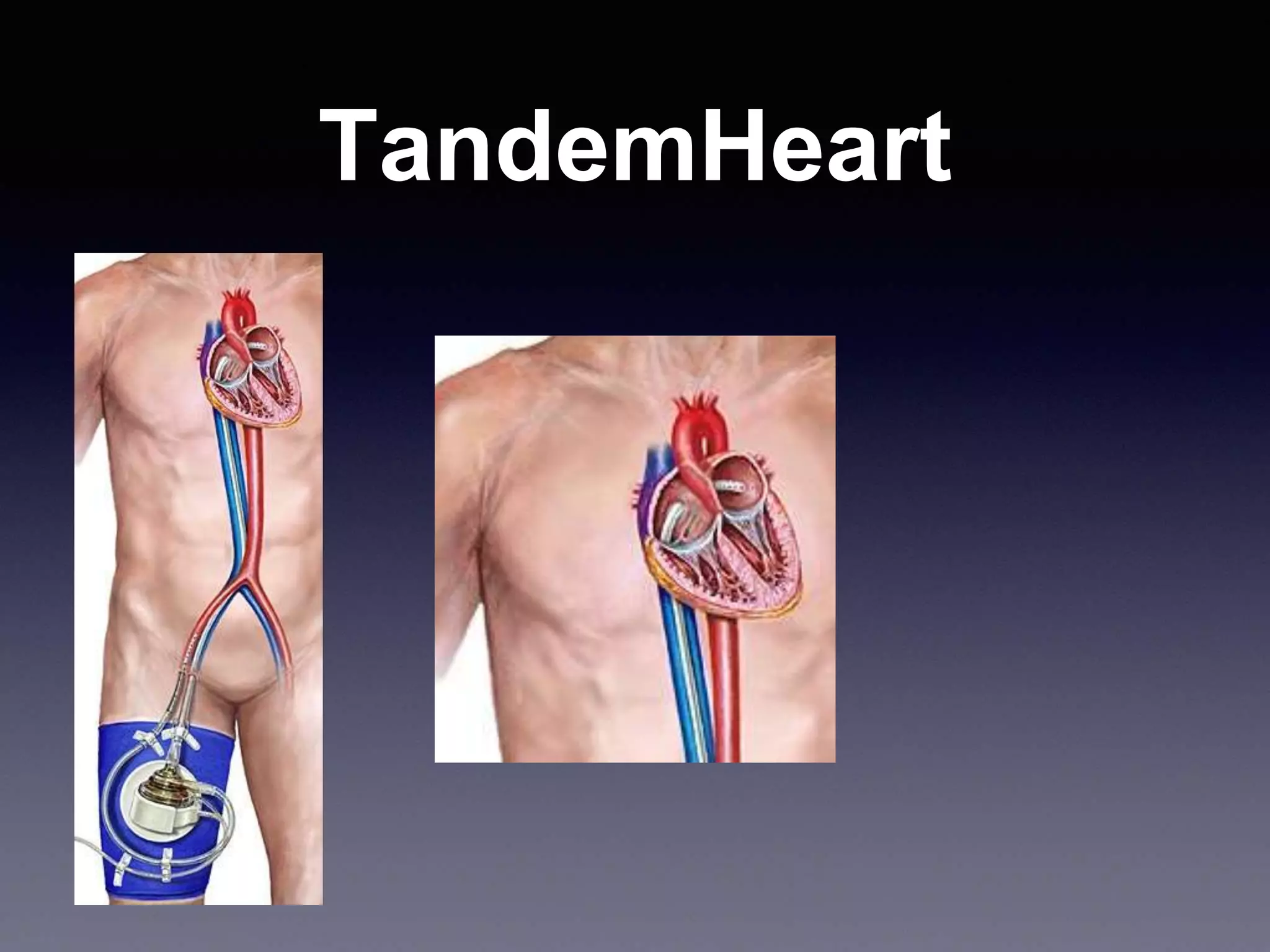 TandemHeart
 