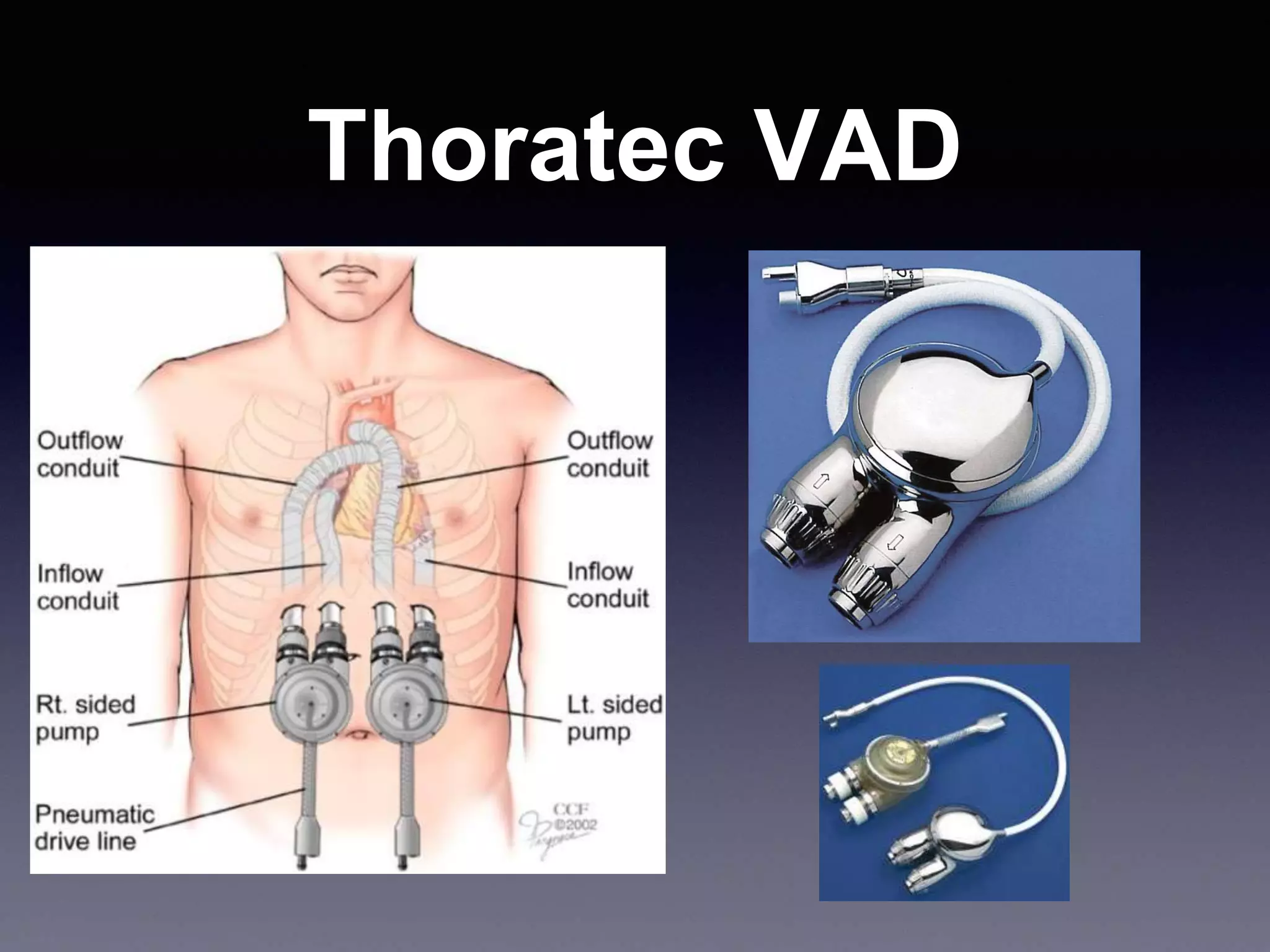 Thoratec VAD
 