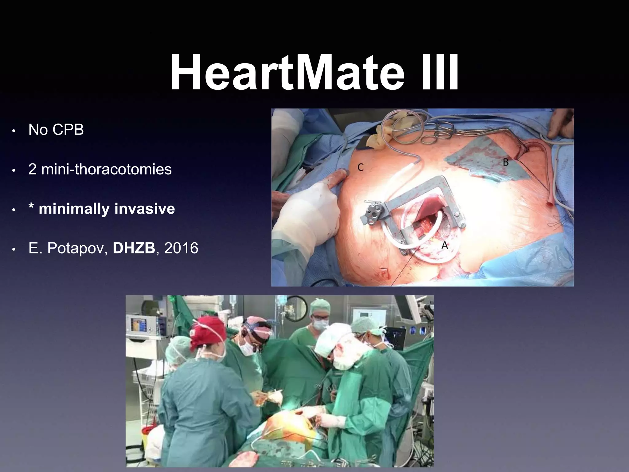 HeartMate III
• No CPB
• 2 mini-thoracotomies
• * minimally invasive
• E. Potapov, DHZB, 2016
 